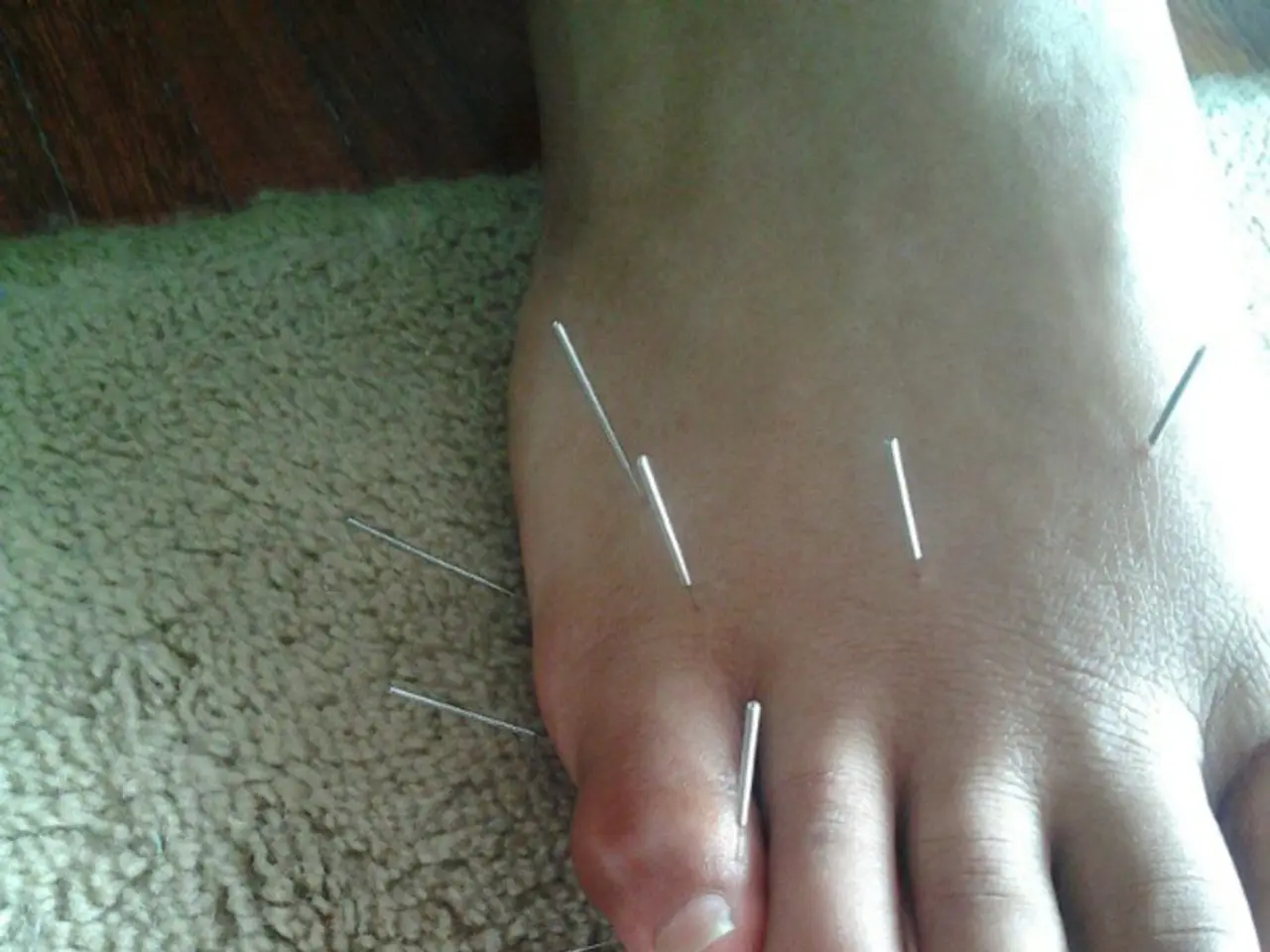 Exercising to Reduce or Eliminate Varicose Veins