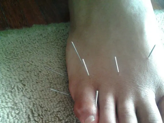 Exercising to Reduce or Eliminate Varicose Veins